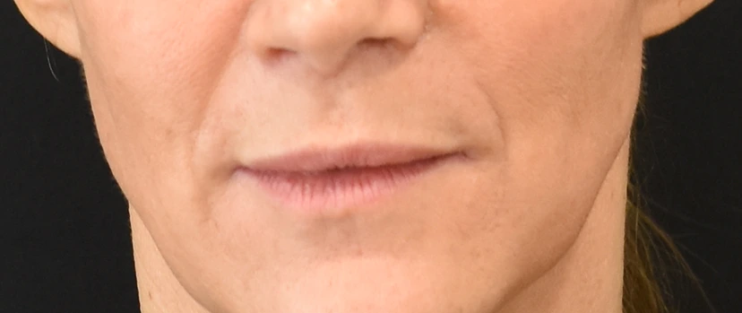 Lip Lift Patient 8 Set 1 Before